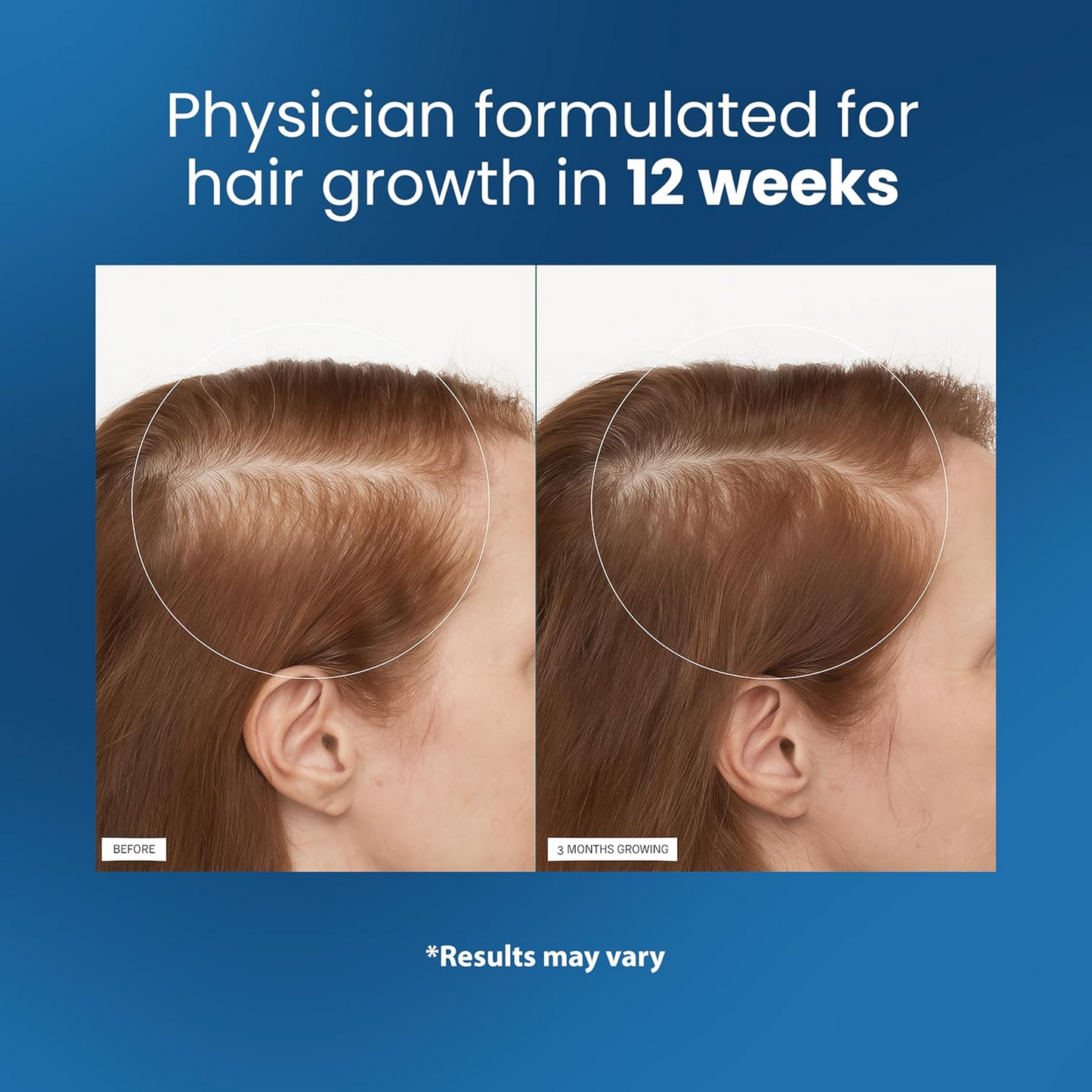 Be Bodywise Advanced Hair Growth Roll-On Serum | 3% Rosemary | 2% Aminexil | 3% Redensy l 2% Anagain | Precision Scalp Applicator | Paraben & Sulphate Free | Non oily and mess free